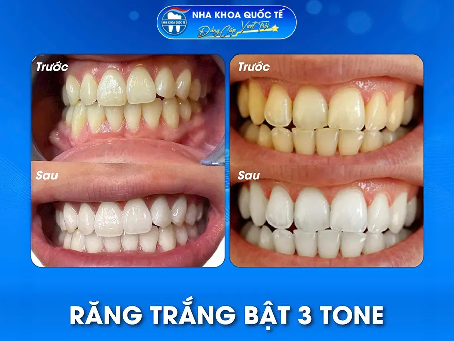 Tẩy trắng răng tại nha khoa quốc tế Hạ Long