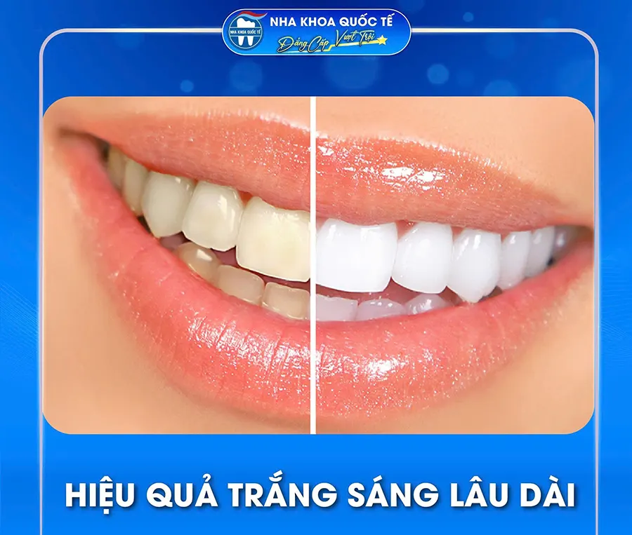 Hiệu quả tẩy trắng răng lâu dài