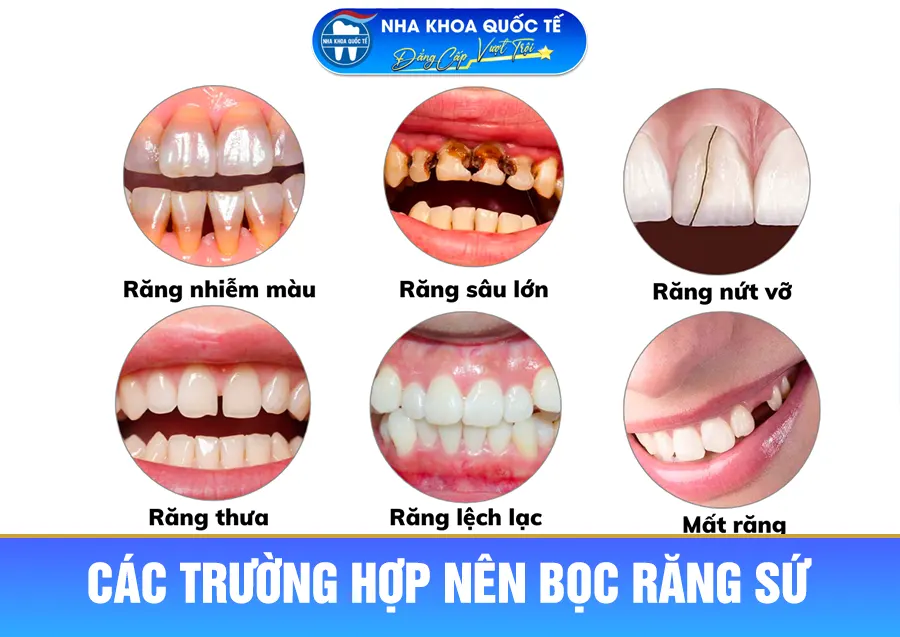 Trường hợp nên bọc răng sứ