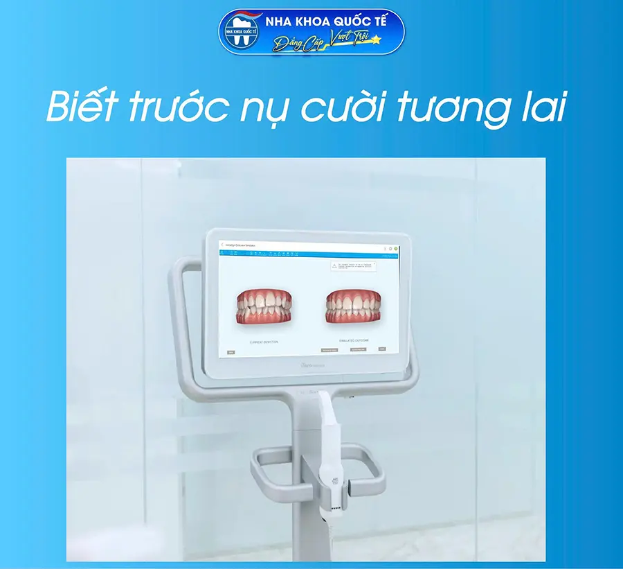 biết trước nụ cười tương lai với itero