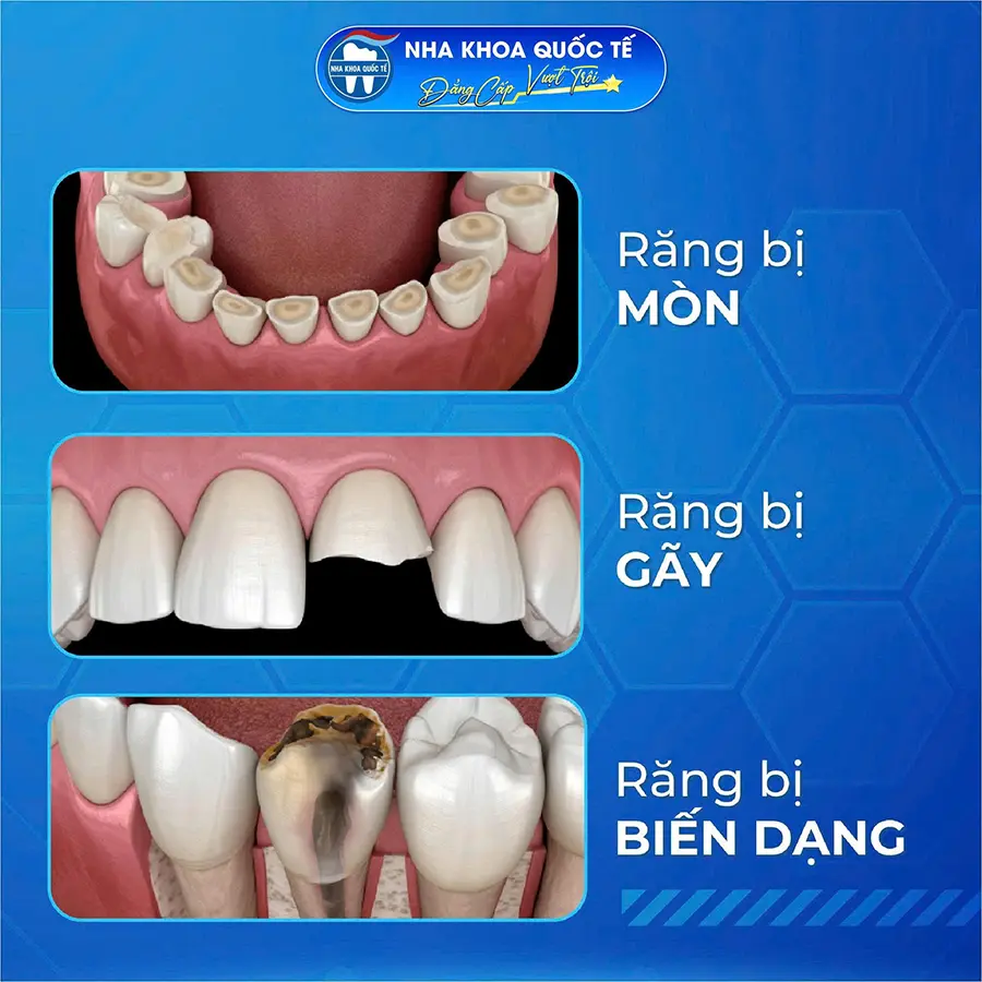 răng bi mòn biến dạng