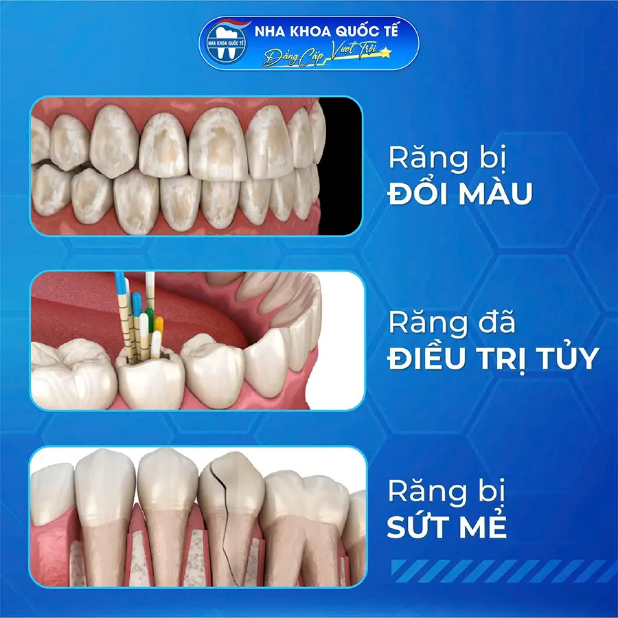 trường hợp làm răng sứ 1