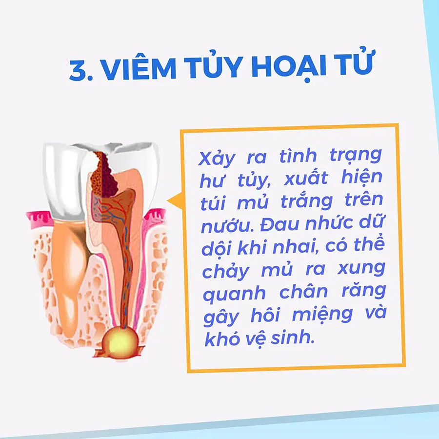 viêm tủy răng hoại tử