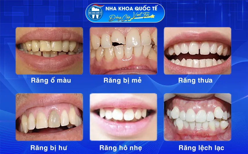 Các trường hợp cần bọc răng sứ