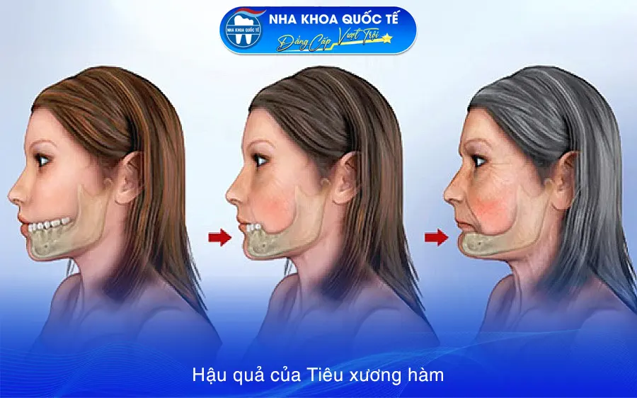 hậu quả tiêu xương hàm