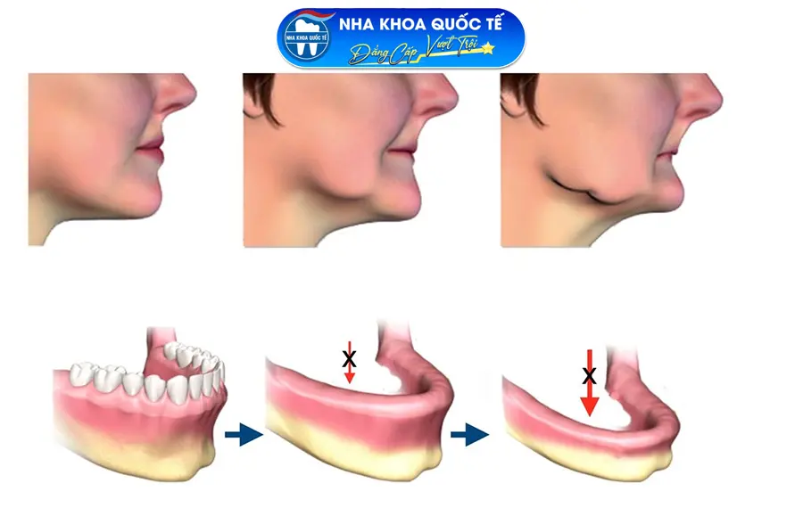 Hình ảnh bệnh nhân bị tiêu xương hàm