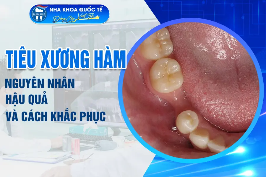 nguyên nhân tiêu xương hàm