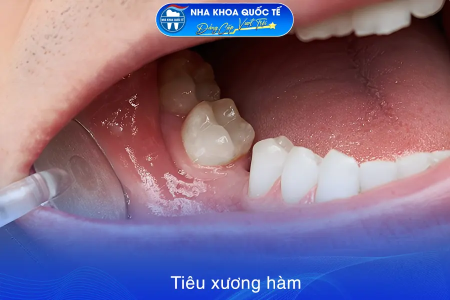 tiêu xương hàm