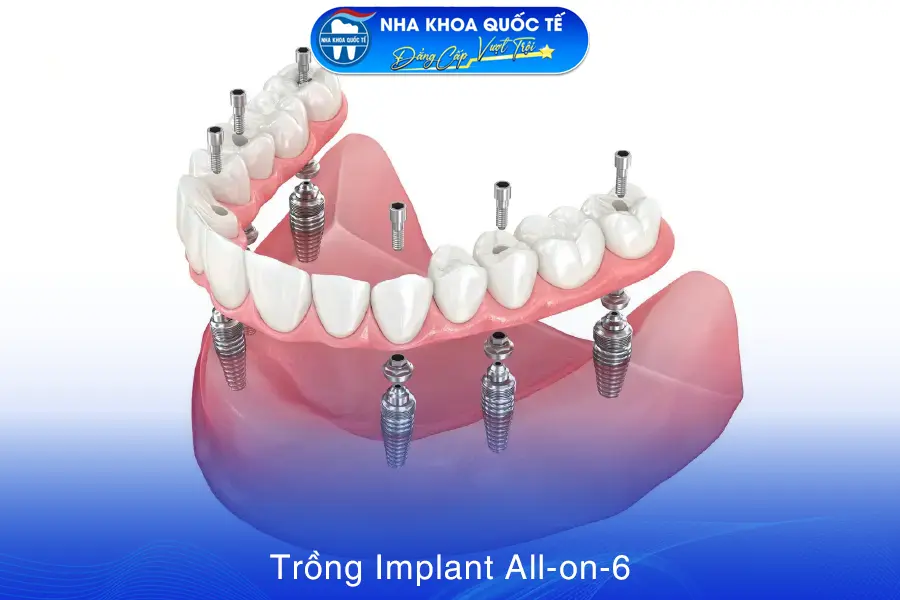 Trồng răng Implant all on 6