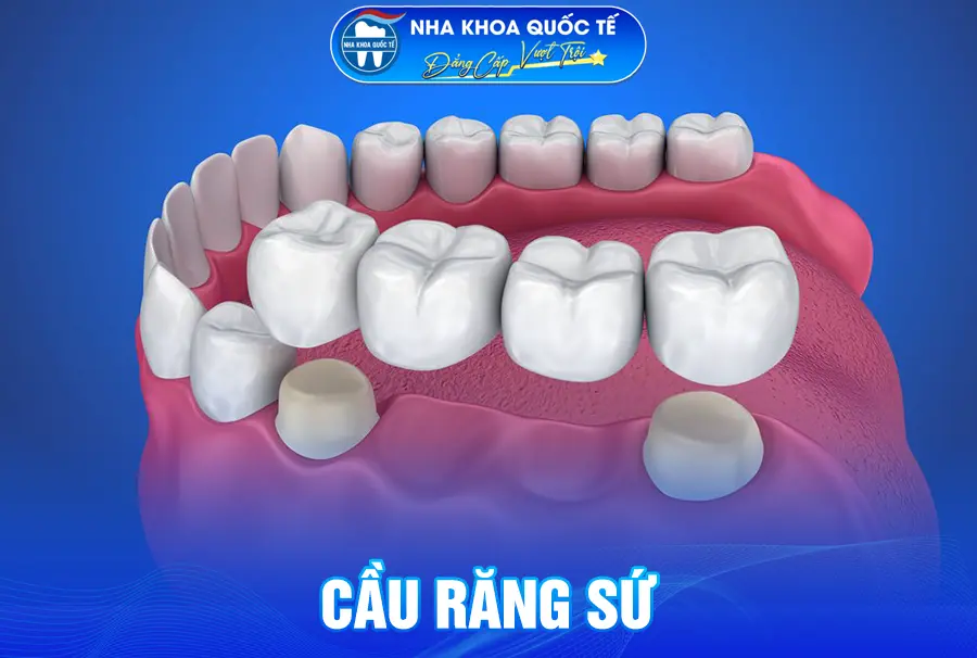 Cầu răng sứ