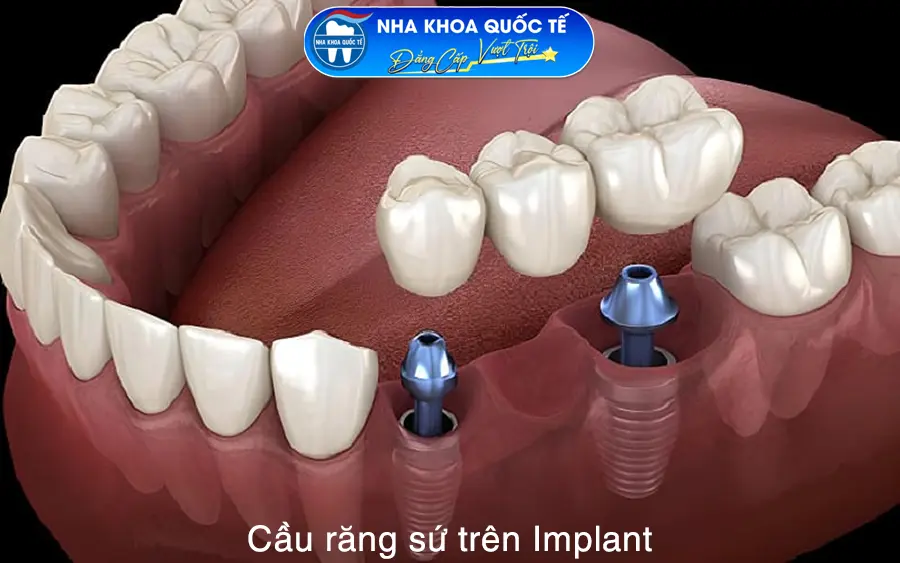 Cầu răng sứ trên implant