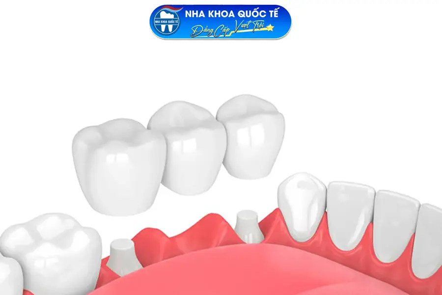 cầu răng sứ truyền thống