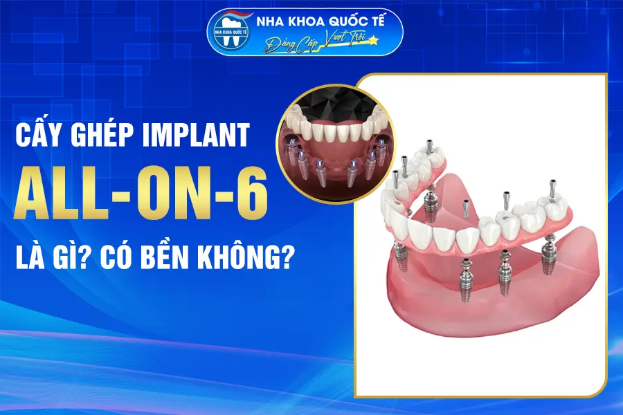 cấy ghép all on 6