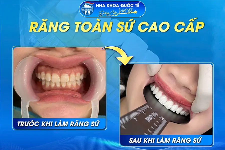 Răng toàn sứ cao cấp