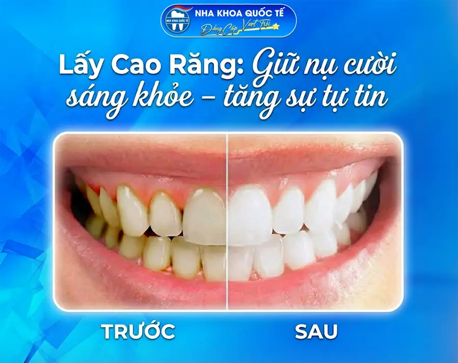 tác dụng lấy cao răng 2