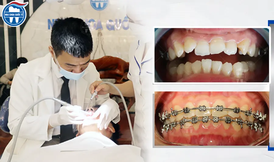 Niềng răng tại Quảng Yên