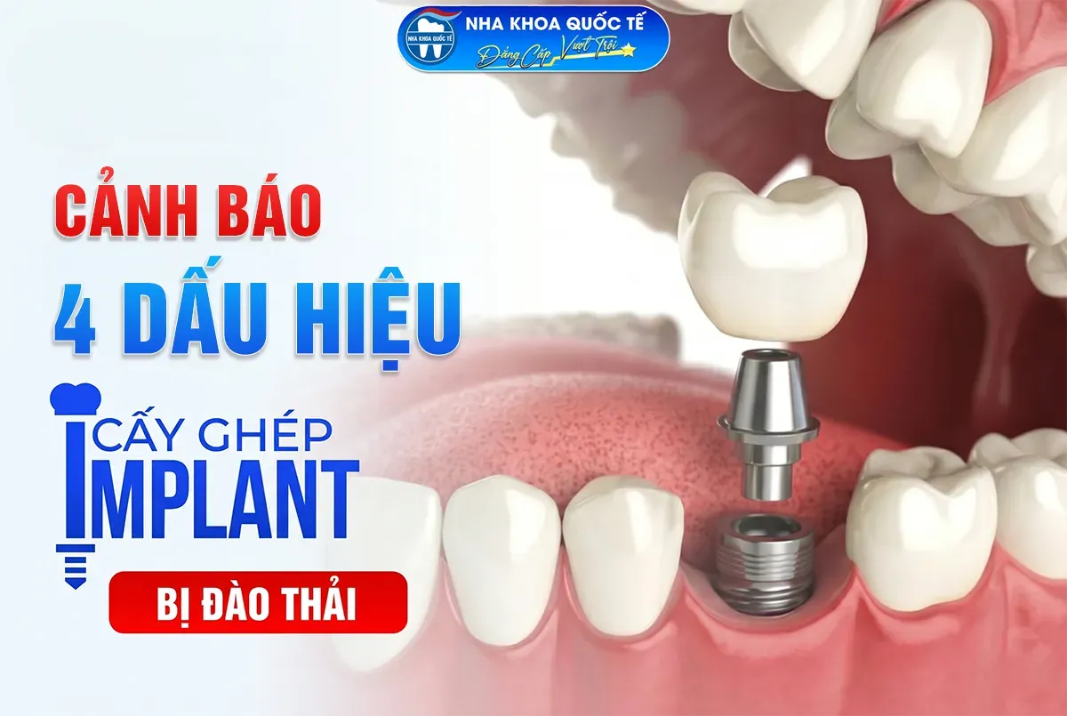 4 dấu hiệu implant đào thải