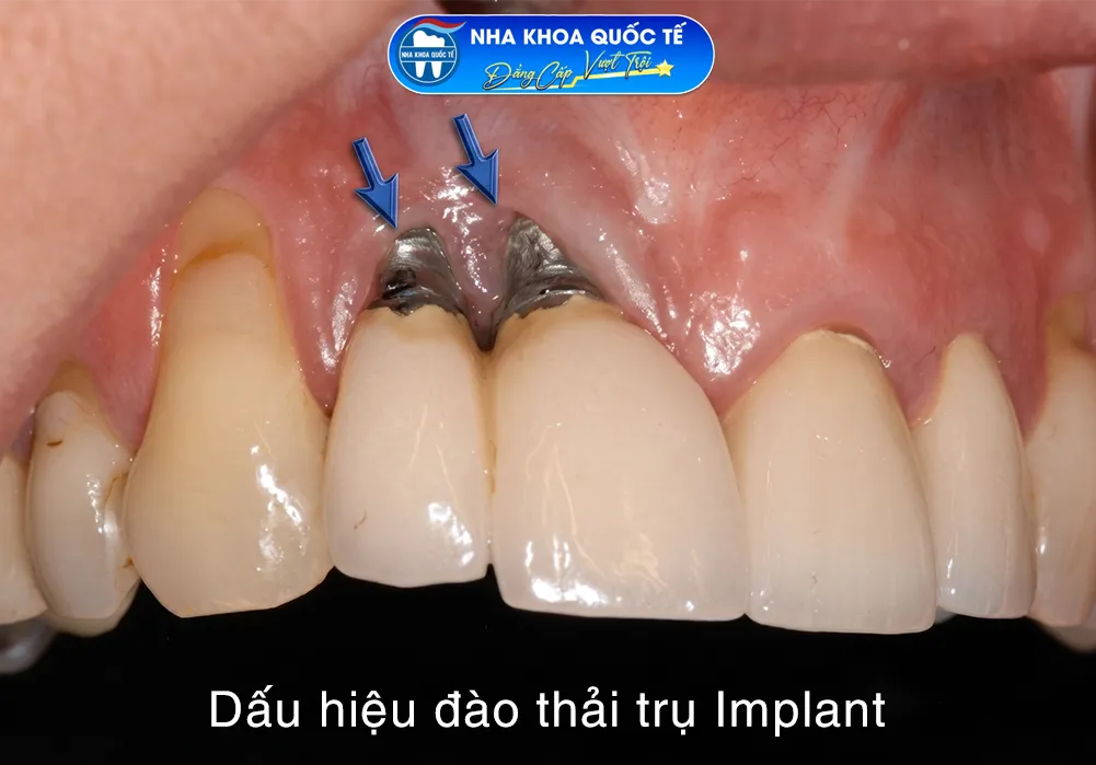 dấu hiệu đào thải trụ Implant