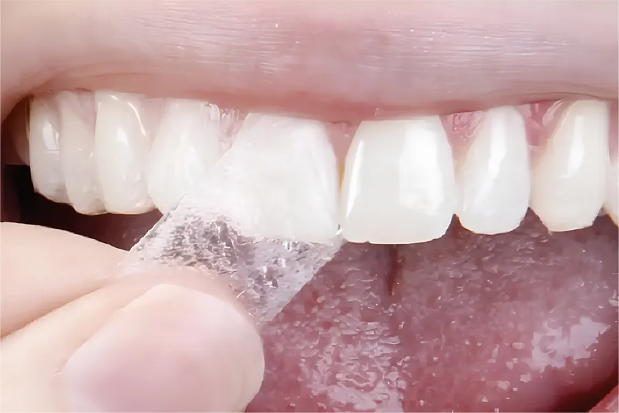 miếng dán trắng răng