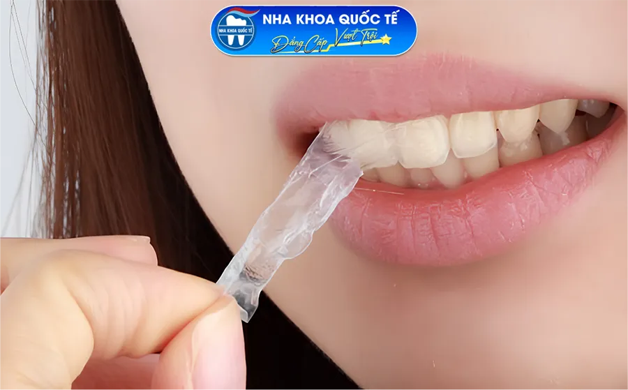 tự dán trắng răng