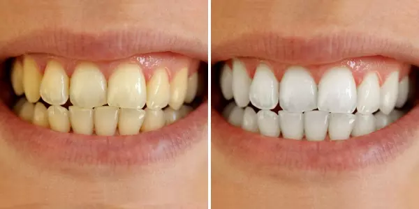teeth-whitening-before-after