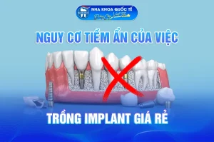 Trồng implant giá rẻ