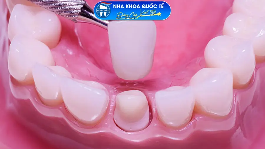 Bọc răng sứ Hạ Long