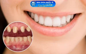 Bọc răng sứ cải thiện thẩm mỹ
