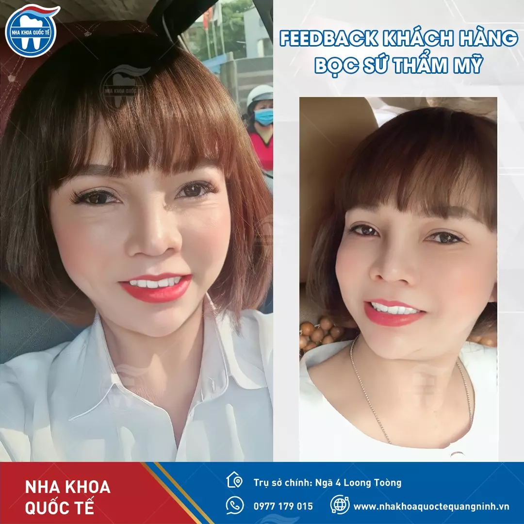Hình ảnh khách hàng làm răng sứ