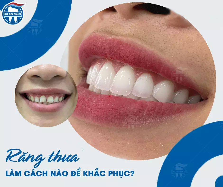 Khắc phục răng thưa