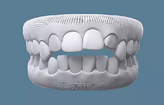 Niềng răng bị hở khớp cắn 