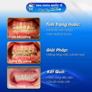 Niềng mắc kim loại