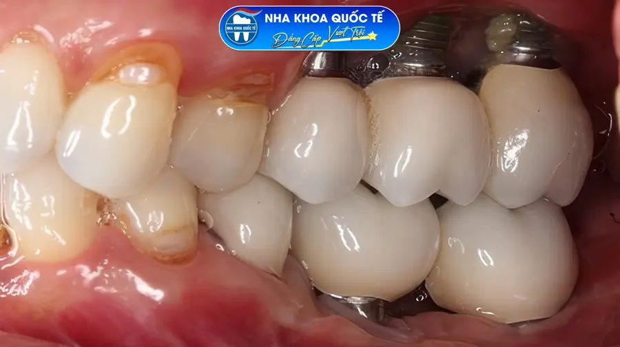 Viêm implant