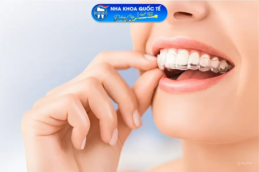 Niềng răng Invisalign