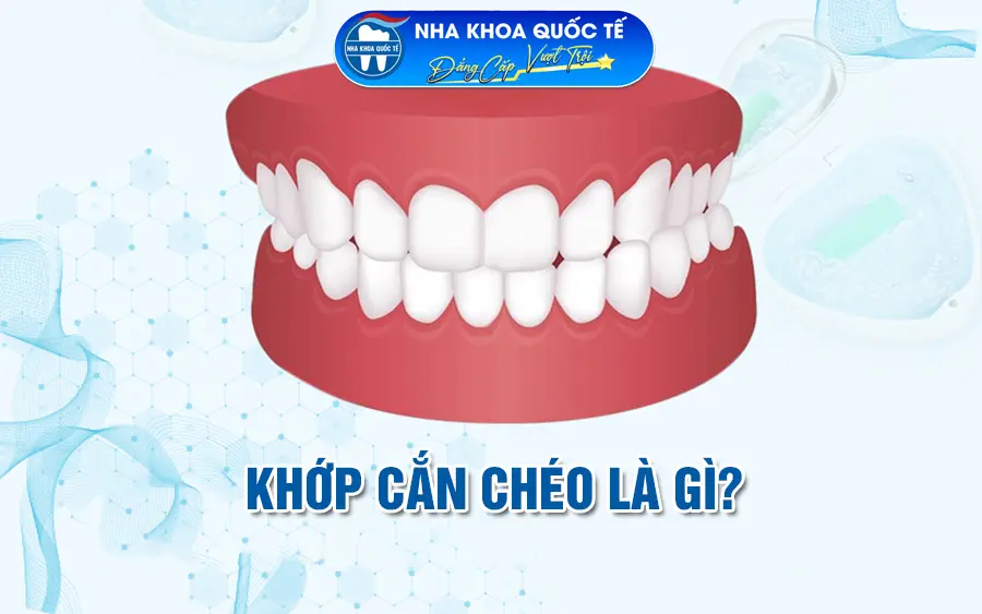 Khớp cắn chéo là gì?