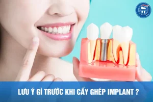 Những lưu ý khi ghép implant