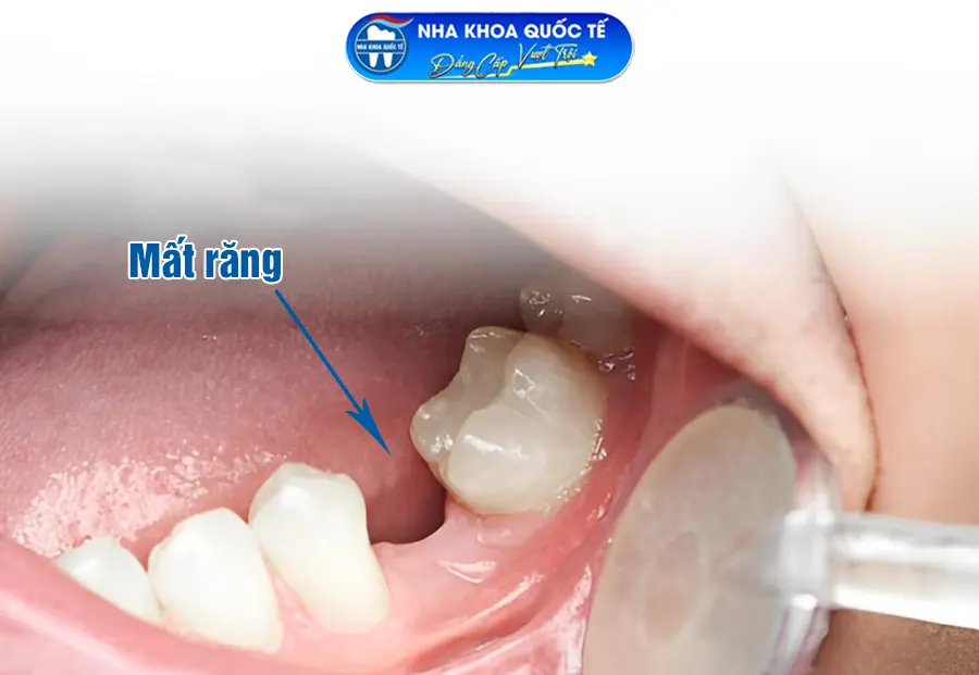 Mất răng do không điều trị viêm lợi