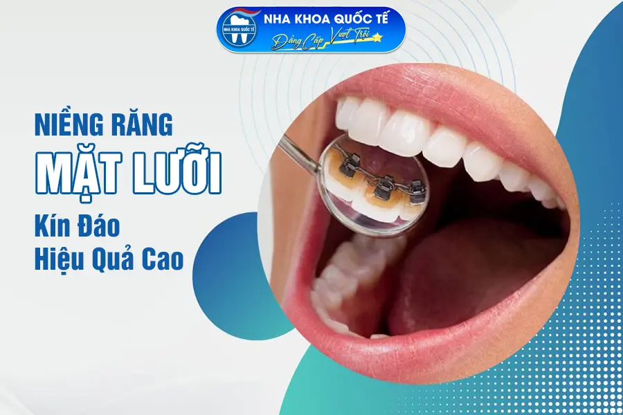 Niềng răng mặt lưỡi