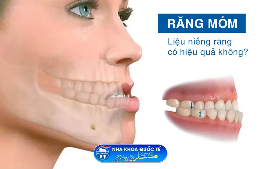 Niềng răng móm có hiệu quả