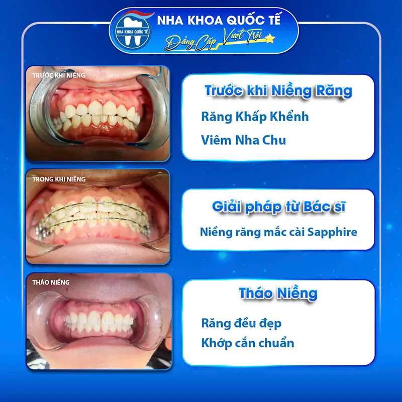 Niềng răng tại nha khoa quốc tế