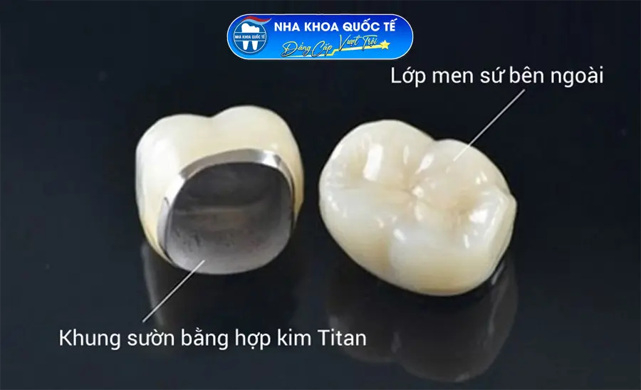 Răng sứ Titan