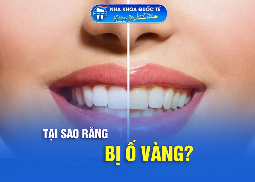 Tại sao răng bị ố vàng