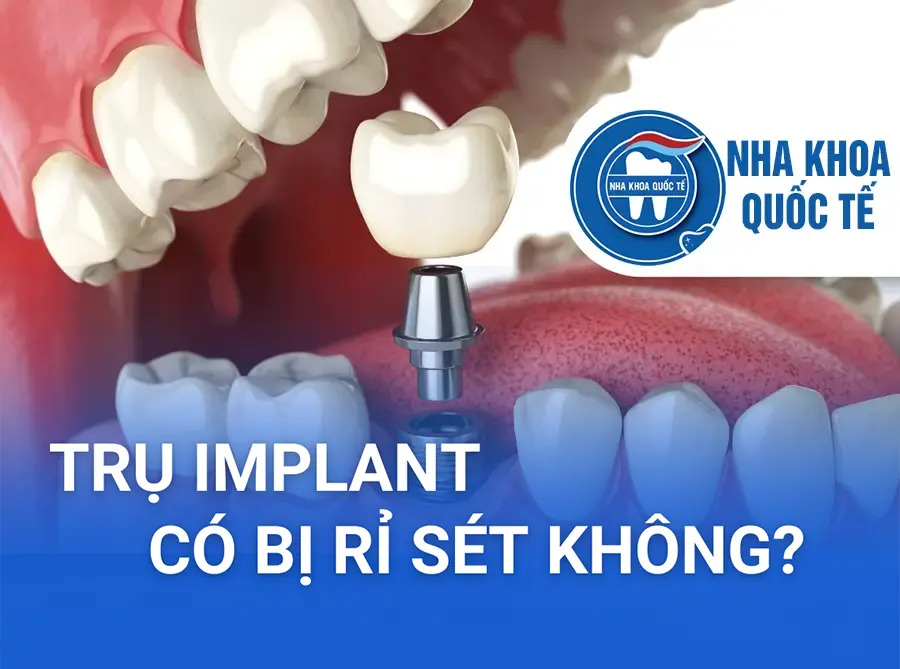 Trụ implant có bền không?