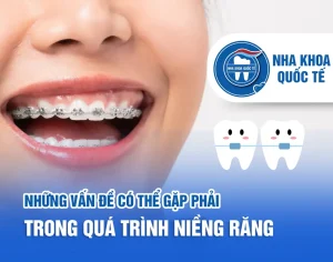 Vấn đề khi niềng răng