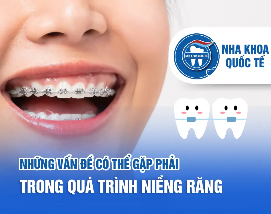 Vấn đề khi niềng răng