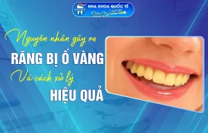 Răng bị ố vàng