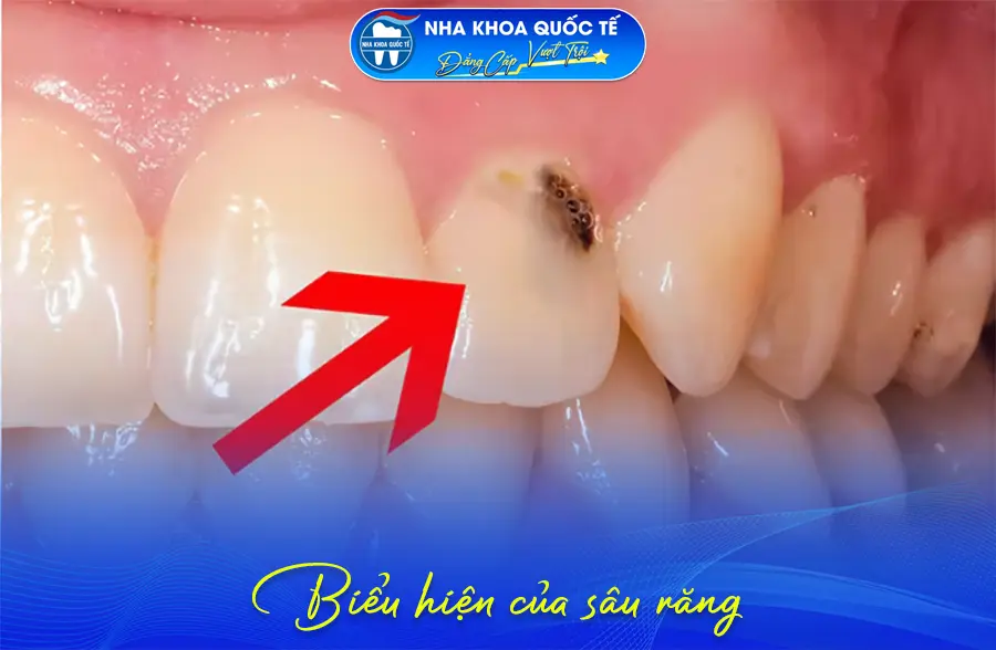 Biểu hiện của sâu răng