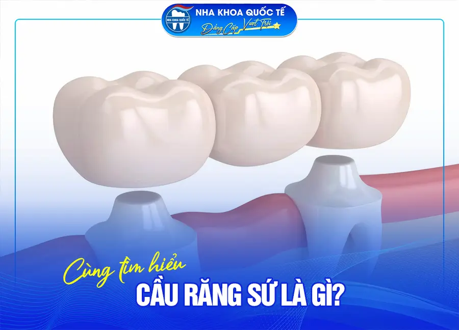 Cầu răng sứ là gì?