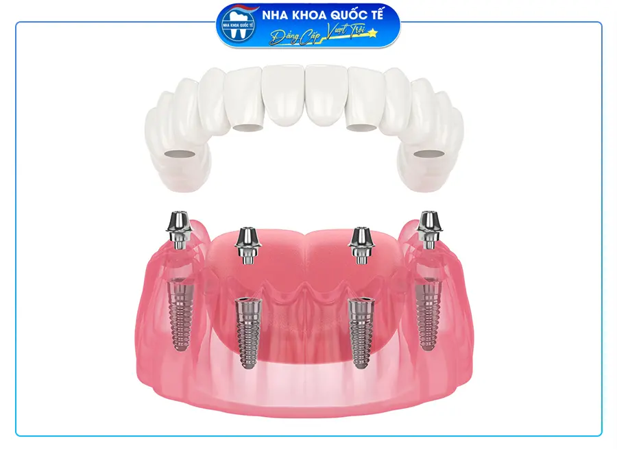 Cấy ghép implant Toàn hàm