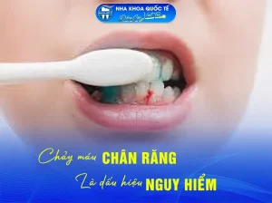 chảy máu chân răng